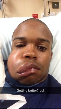 Delino DeShields Jr : Balle de Baseball en plein visage