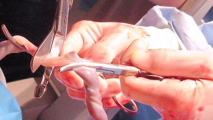 Pregnancy: What to Expect Week 35 -- Cord Blood Donation