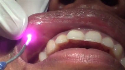 Laser Biostimulation for Apthous Ulcer in India