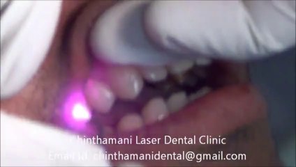 Laser Biostimulation for Herpes Simplex in Lip