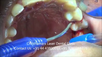Laser Gum Treatment (LANAP) in chennai part-2