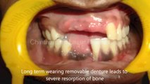 Basal implant treatment in chennai