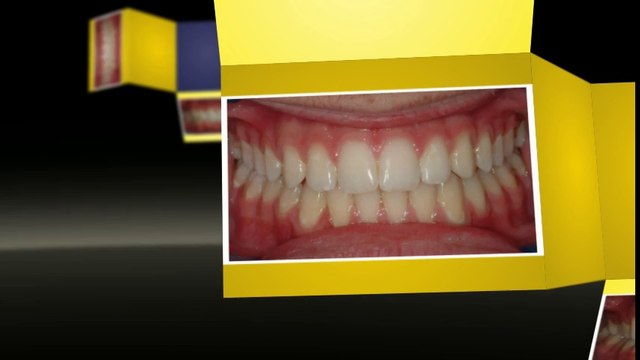 Invisalign Littleton Feb2014