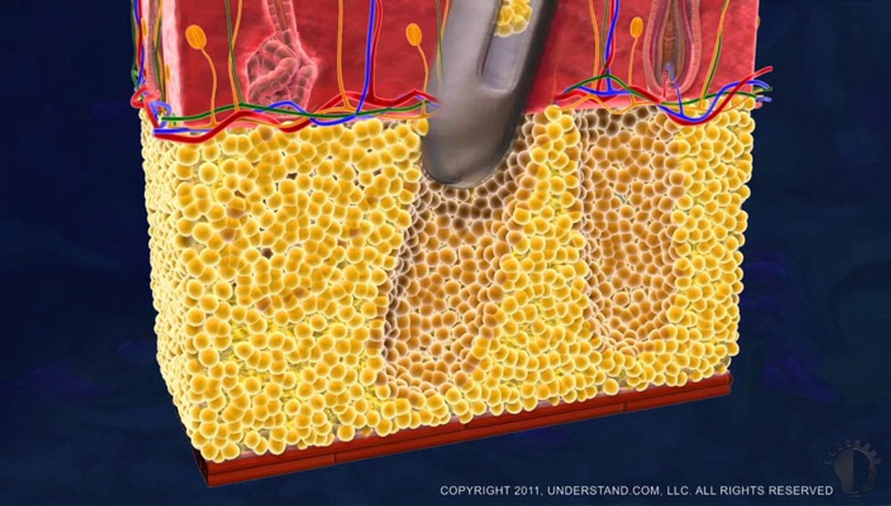 Liposuction