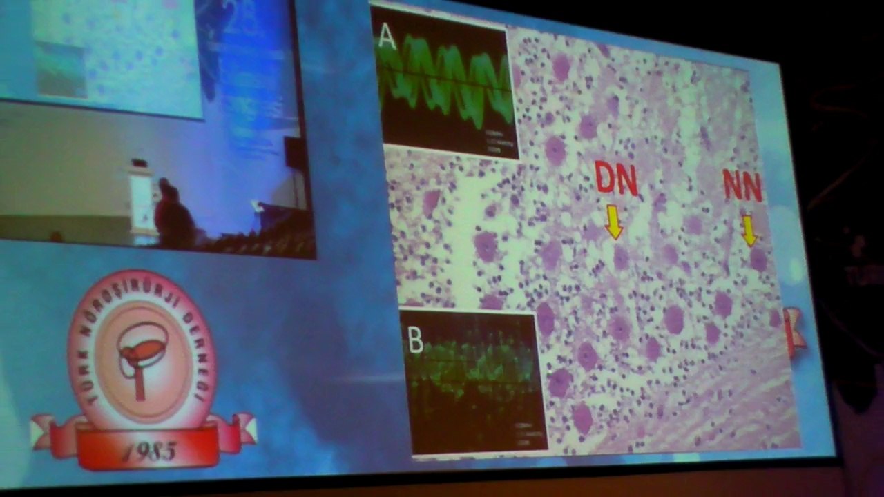 2014 Türk Nöroşirürji Derneği 28 Kongresi Prof Dr Mehmet Dumlu Aydin Ses Dalgaları
