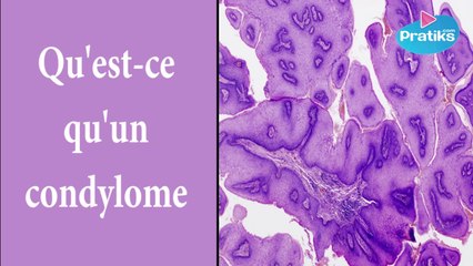 Proctologie - Qu'est-ce qu'un condylome