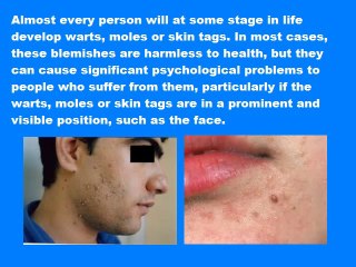 How To Get Rid of Skin Tags