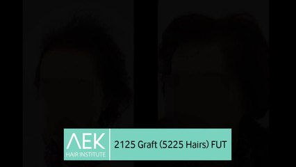 FUT Hair Transplant in Female Patient | AEK Hair Institute