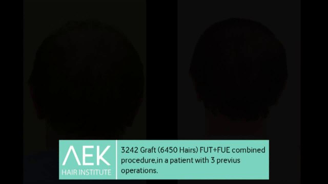 FUT+FUE Hair Transplant | AEK Hair Institute
