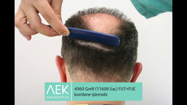 FUT+FUE Saç Ekimi | AEK Hair Institute