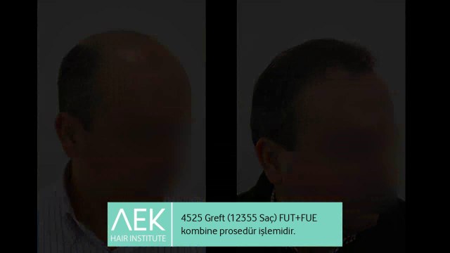 FUT+FUE Saç Ekimi | AEK Hair Institute