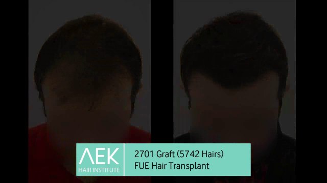FUE Hair Transplant | AEK Hair Institute