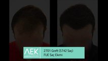 FUE Saç Ekimi | AEK Hair Institute