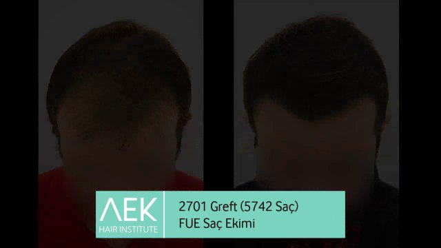FUE Saç Ekimi | AEK Hair Institute