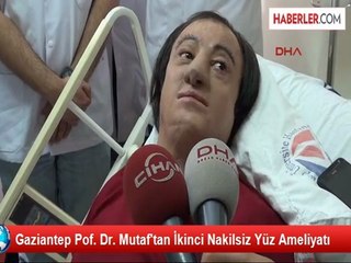 Gaziantep'te 2. Kez Nakilsiz Yüz Yapıldı