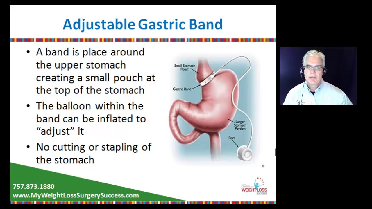 What are the best weight loss surgery options?