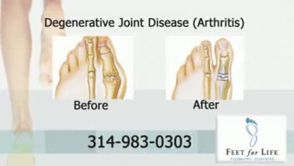 Feet For Life St. Louis - Bunion Surgery Reviews