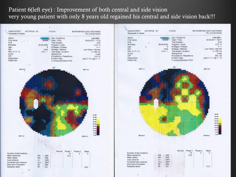 Medical Test Results of Patients with Retinitis Pigmentosa - Electro-Acupuncture Therapy - FIRATLI CLINIC