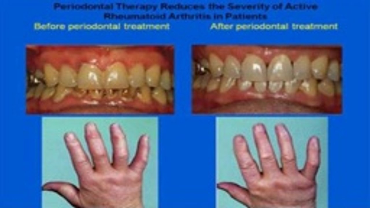 Dental News Saliva | Cancer | Arthritus | John Lennon