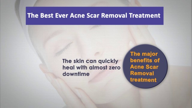 The Best Ever Acne Scar Removal Treatment