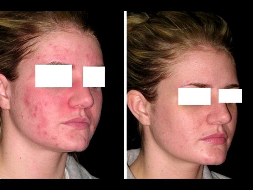 Acne No More- This changed my Life!