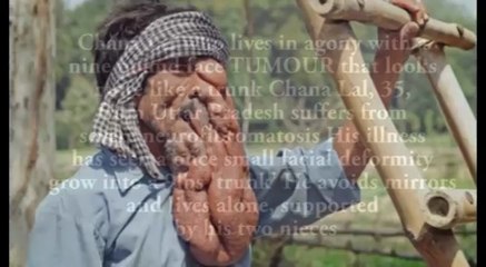 Indias Elephant Man with a Trunk