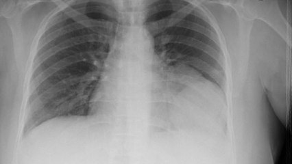 Man's Heart Jumps to His Right Side After Accident