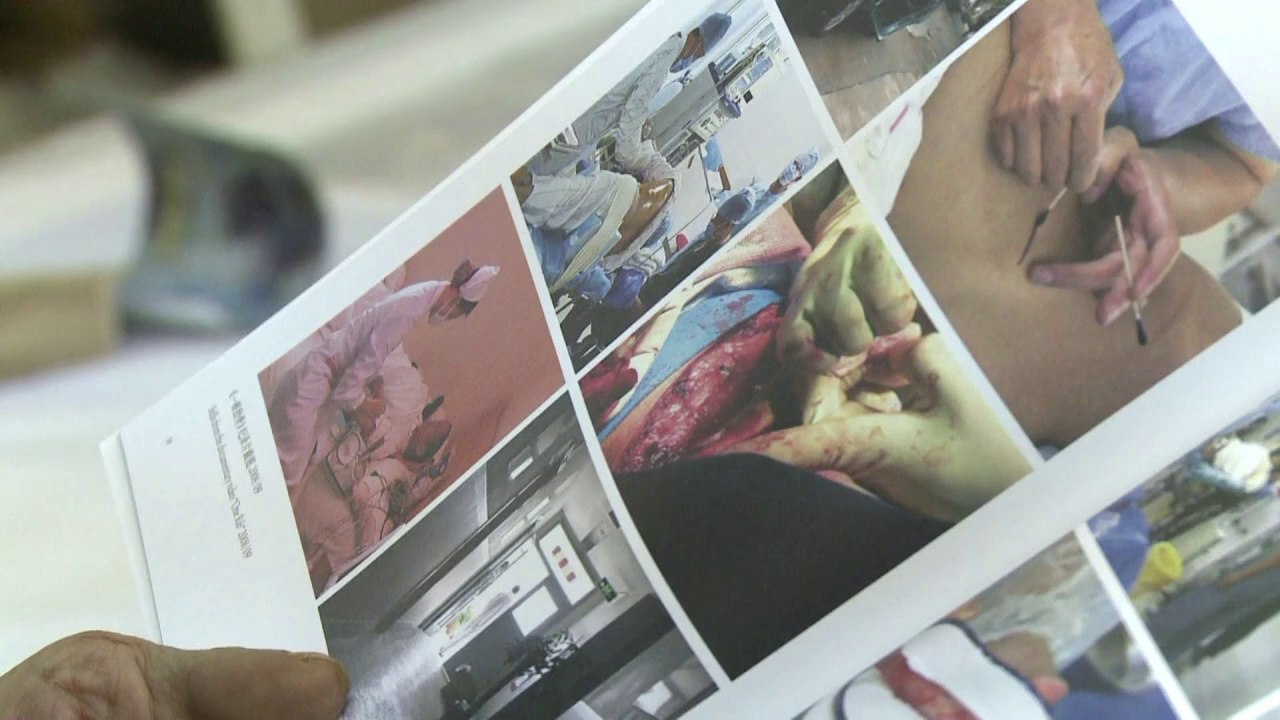 Ekel-Kunst: Chinese fertigt Halskette aus eigener Rippe