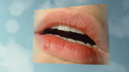 Melanie Addington - Ultimate Herpes Protocol  Honest Review