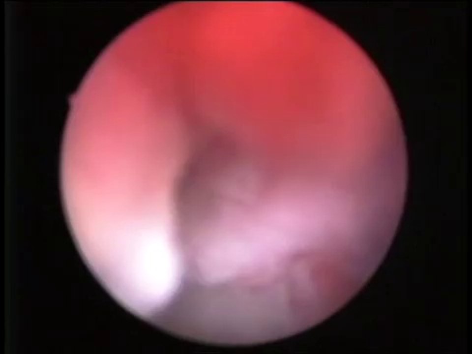 Endomerial Polip Tedavisi  2