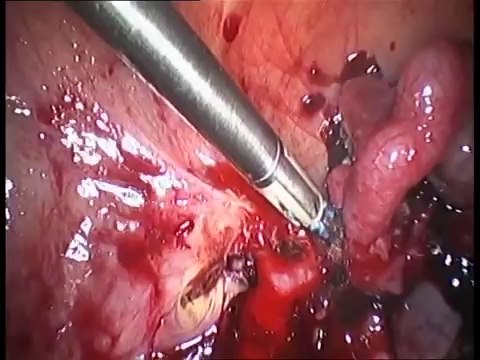 İstmik Yerleşimli Dış gebelik Ameliyatı