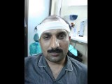 Cheap Fue pakistan, Fue in pakistan, Best hair transplant in pakistan
