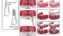 Implants for Missing Teeth, With Dentist Dr. David Little, San Antonio, Texas