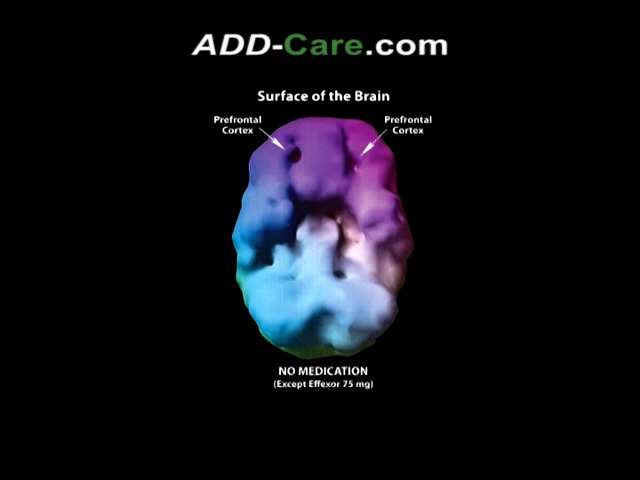 attention-deficit-disorder