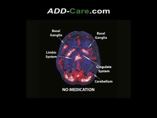 Discover the 6 Types of ADD According to Dr. Amen 🧠
