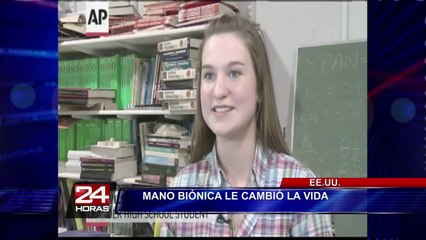 EEUU: crean una mano biónica para niño con malformación congénita