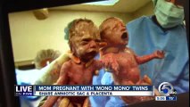 US twin baby sisters born holding hands