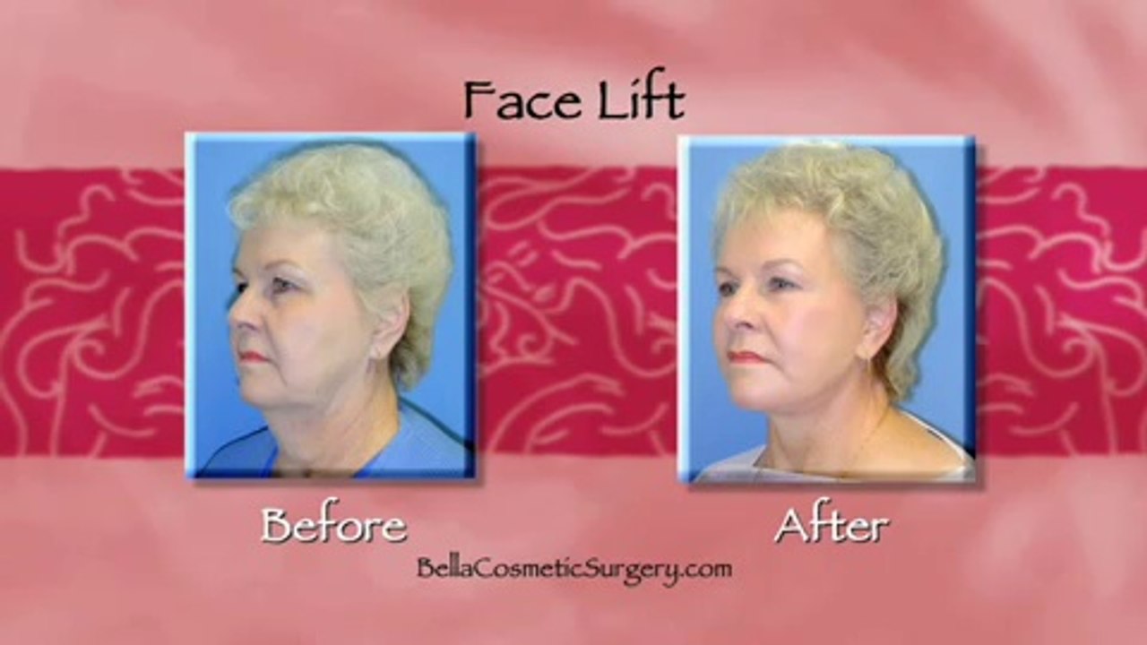What Happens After a Face Lift? Maryland Patients Need to Watch This.