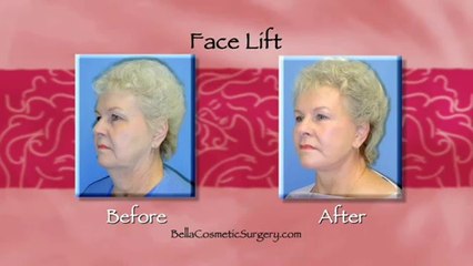 What Happens After a Face Lift? Maryland Patients Need to Watch This.