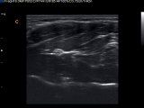 How to find median nerve  with Chison Q9 Color Doppler Ultrasound