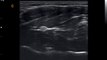 How to find median nerve  with Chison Q9 Color Doppler Ultrasound