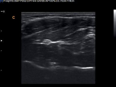 How to find median nerve with Chison Q9 Color Doppler Ultrasound