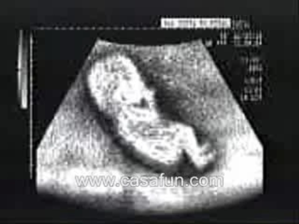 Echo bebe