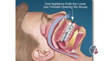 Alternatives to CPAP Devices for Sleep Apnea, Dentist Dr. David Little, San Antonio, Texas