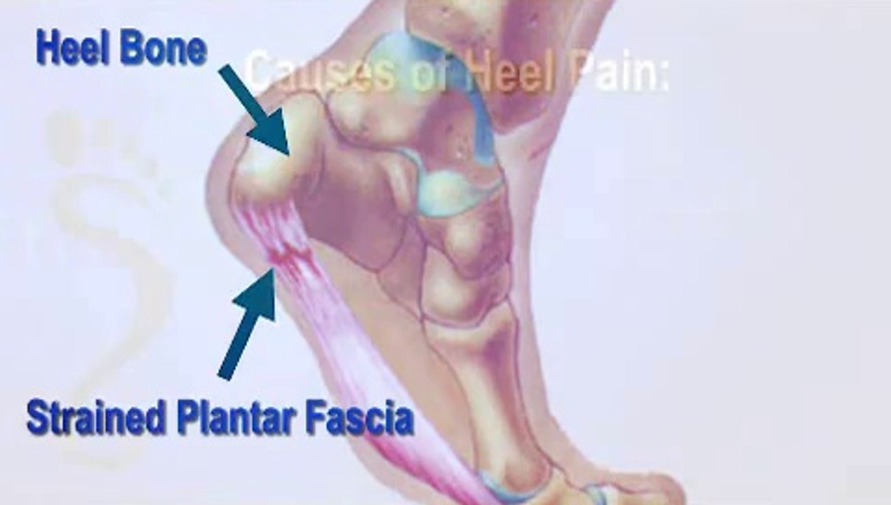 Hackensack, Teaneck and Maywood, NJ - Heel Pain - Podiatrist John Guadara,