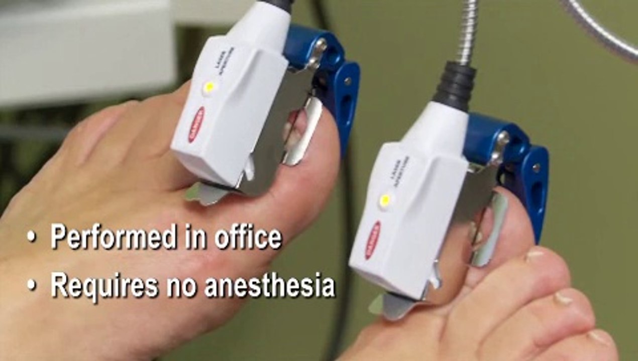 Rocky Hill, Middletown and Bristol, CT -Laser for Fungal Toenails - Podiatrist  Jeffrey Kahn