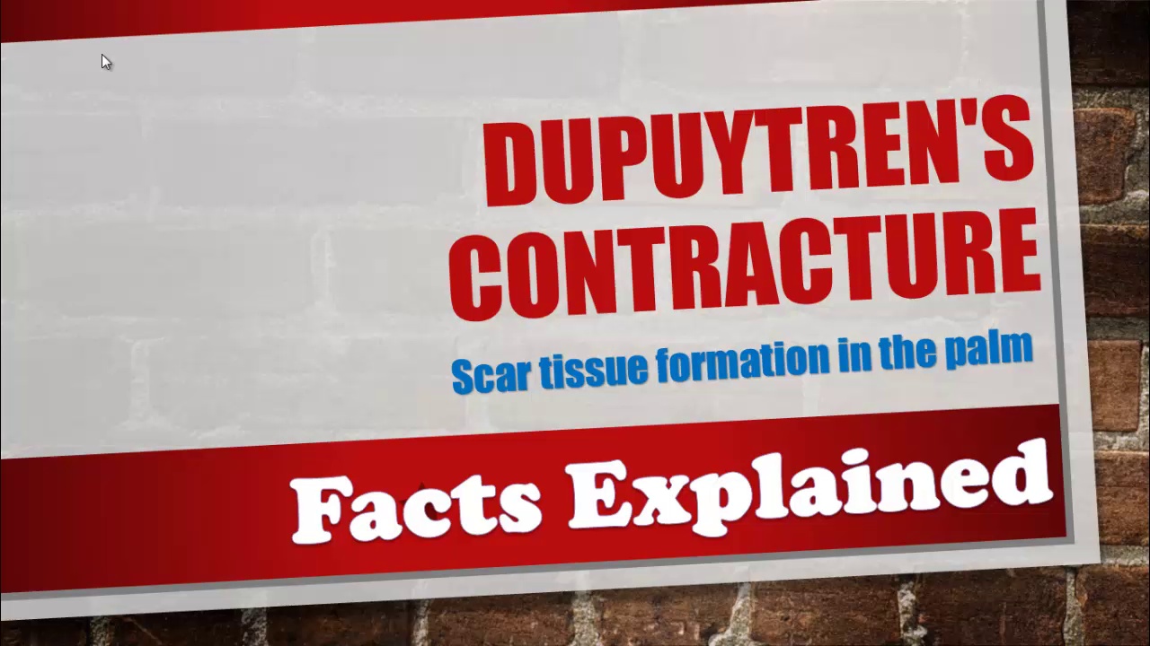 Dupuytren's contracture