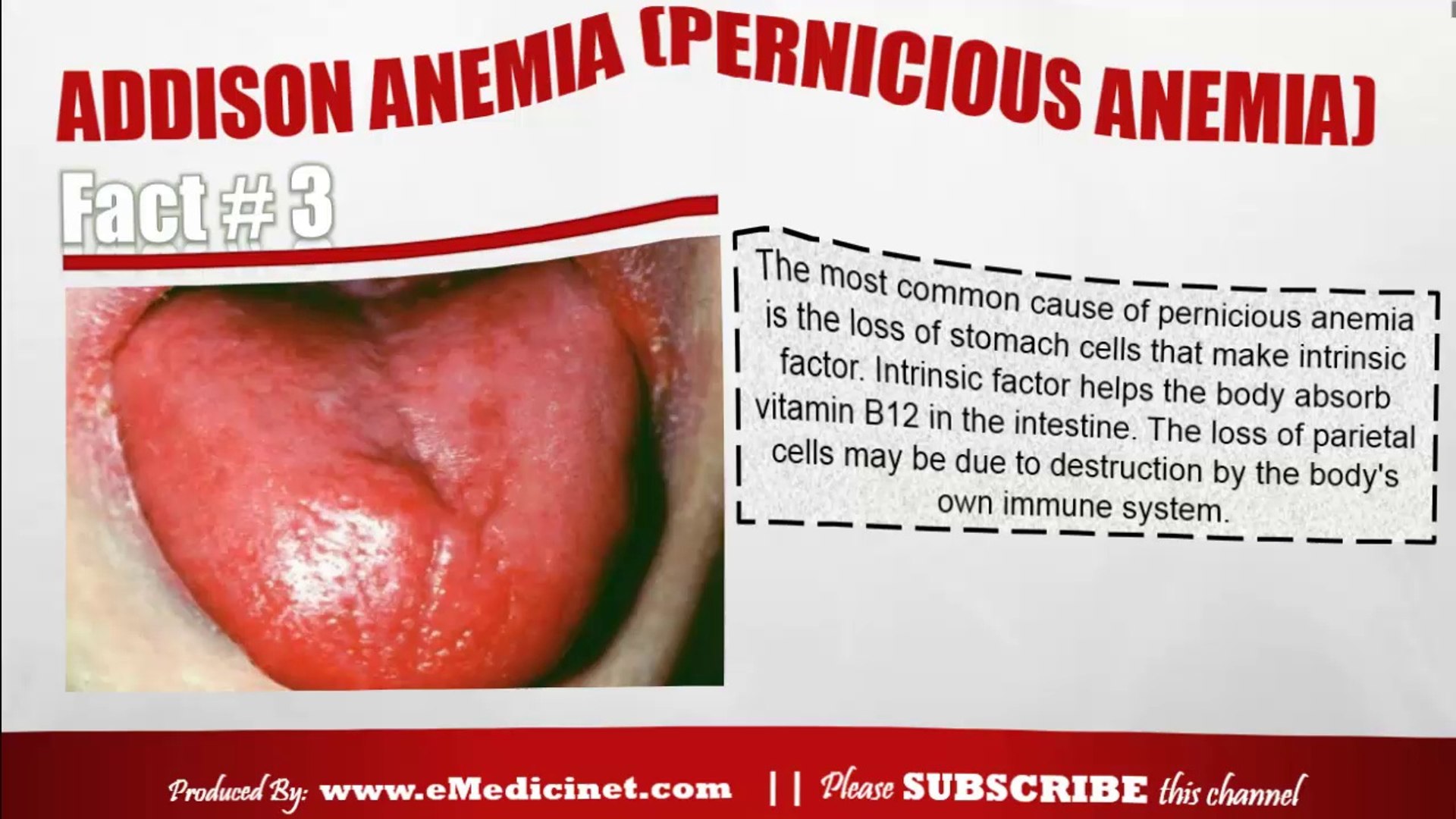 Pernicious Anemia Tongue