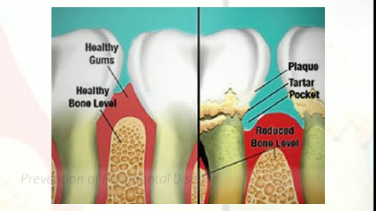 Invisalign in Hershey
