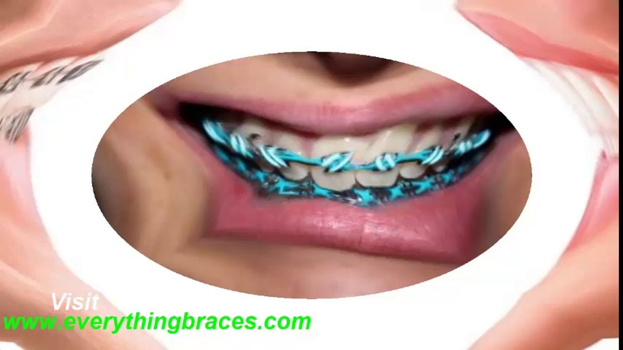 braces cost